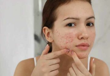What Does It Mean When You Dream About Having Pimples All Over Your Face?